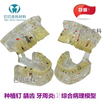 Dental loss pathology Dental model Crystal transparent adult tooth comprehensive pathology model elongation pathology