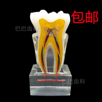 Oral Section Teaching aids 6 times teeth Neuroanatomy tooth model Crystal base Medical patient Communication Model