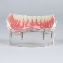 Dental Oral Section Model Medical patient Communication 4 Nail Model New Cultivation and Restoration Model 