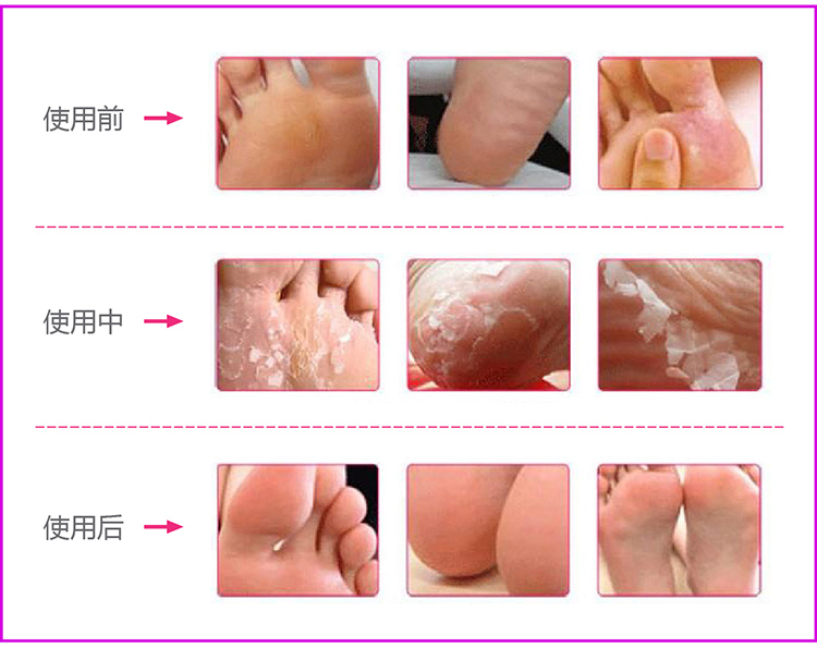 Đấu thầu chân lột chân phim mặt nạ chân thiết lập để chết da callus tẩy tế bào chết chân gót chân khô nứt chăm sóc bàn chân thuốc trị nứt chân