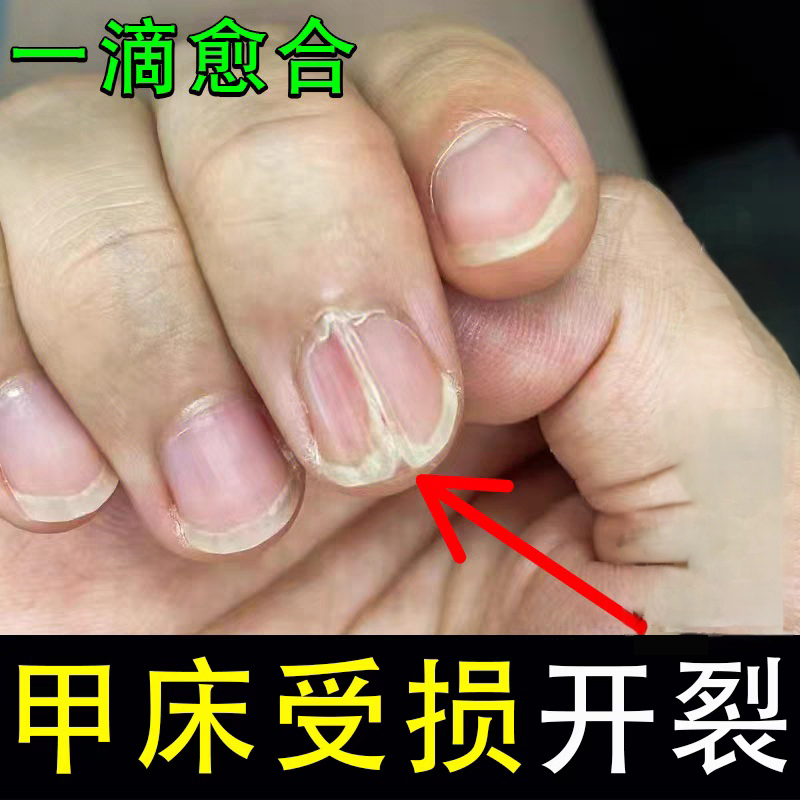 Specialized Treatment Solution for Cracked Nails, Repairing Vertical Lines, Damaged Nail Flesh Separation, Middle Nail Surface Separation, Hollow Nails, Uneven Nail Surface Medication