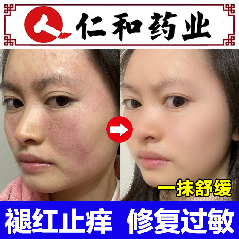 Face ultraviolet allergy skin repair face antipruritic cream special medicine face dry peeling redness and swelling rash itch cream
