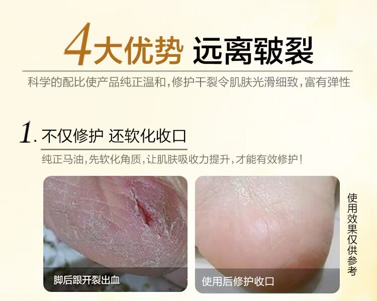 Gót chân khô nứt nẻ nứt nẻ chống chân nứt nẻ dưỡng ẩm dầu ngựa kem dưỡng da tay kem nữ trị nẻ chân