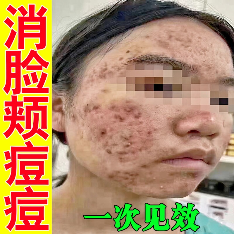 淋巴痘护理知识与淋巴痘护理信息资讯-淘宝美妆网