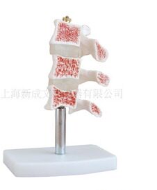 脊椎典型病变模型/脊椎模型/解剖模型/骨质疏松/教学模型XC-134