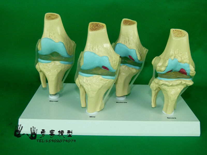 人体四分型膝关节模型 骨关节糜烂演示模型 骨骼骨架教学模型