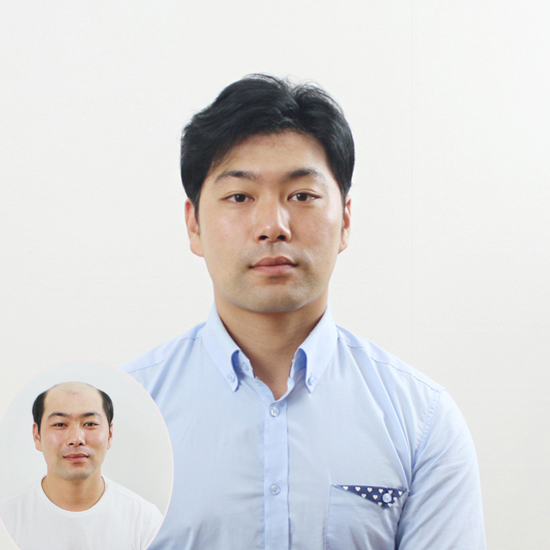 全手织男士卷发头顶假发补发块大背头地中海脱发植发织发短发片