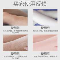 Spot chicken skin removes pimples on legs hair follicles and keratosis J abrasive cream artifact for women with dry skin all over the body