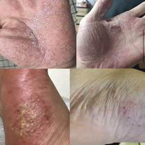 Spot pace palm pus and pus pus hands and feet of the thick foam and skin peeling dry acorosis red spot