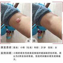 Skin smooth repair cream Scar Removing Cream O Scar relief Scar Repair Cream Surgery Scar Scalds Gestational Mark 2 Send