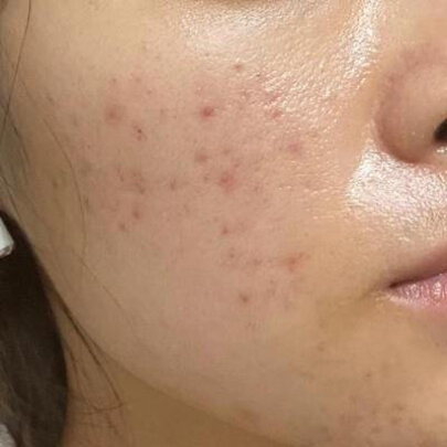 新手必看:壬二酸凝胶15%祛痘面部健康怎么样?专家们分析真相如何
