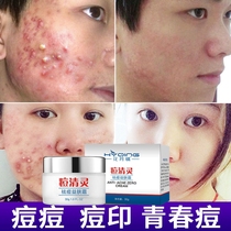 Desalate acne acne cream children children children men and women treatment of beans to repair teenagers but acne marks