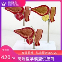 ENOVO Medical prostate disease demonstration model Andrology doctor-patient communication Proliferative cancer BPH prostate