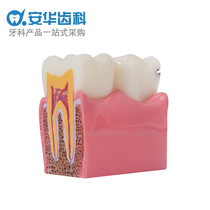Tooth model 6 times caries comparison model Tooth decay demonstration model Profile model Doctor-patient communication teaching model