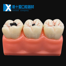 Dental Oral Dental caries evolution model Quadruple caries decomposition model Patient communication model