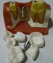 Dental implant model standard model dental implant gum restoration doctor-patient communication student practice tooth preparation explanation