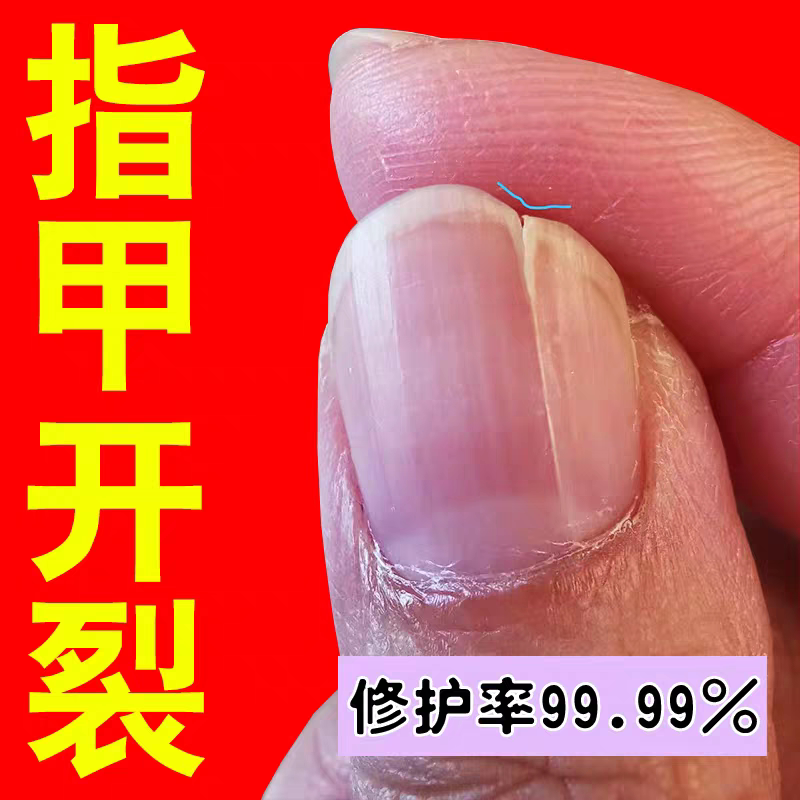 Nail Crack Repair Liquid for Vertical Lines, Cracked Nails, Damaged Nails, Separated Nails, Layered Nails, Uneven Nails, Growth Nail Oil Nail Crack Repair Liquid for Vertical Lines, Cracked Nails, Damaged Nails, Separated Nails, Layered Nails, Uneven Nails, Growth Nail Oil