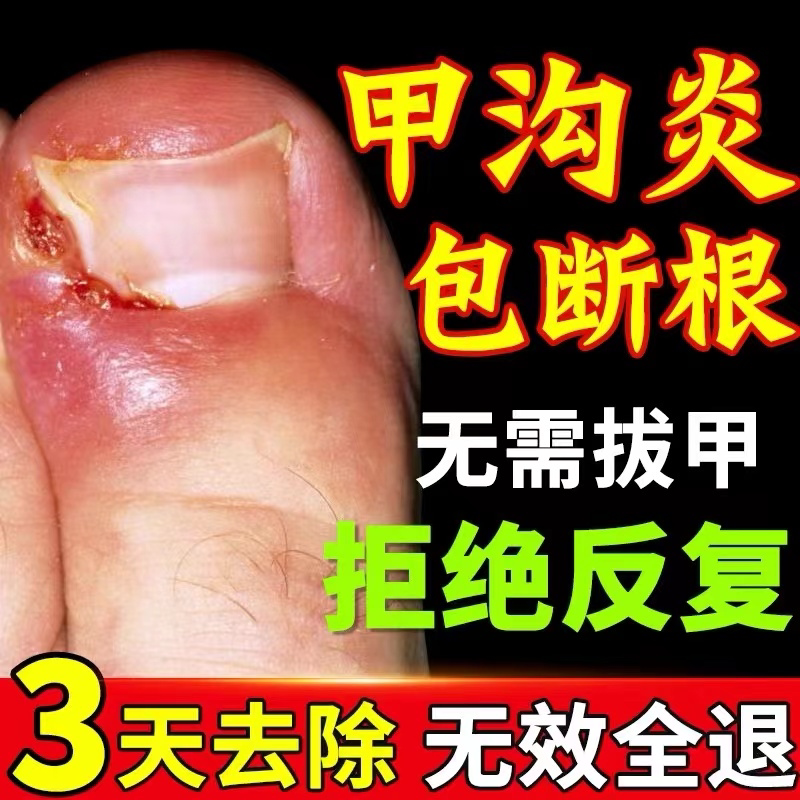 Specialized Medication for Treating Paronychia, Non-Specific Ointment, Polyp Removal, Ingrown Toenail Remover, Nail Softener Specialized Medication for Treating Paronychia, Non-Specific Ointment, Polyp Removal, Ingrown Toenail Remover, Nail Softener
