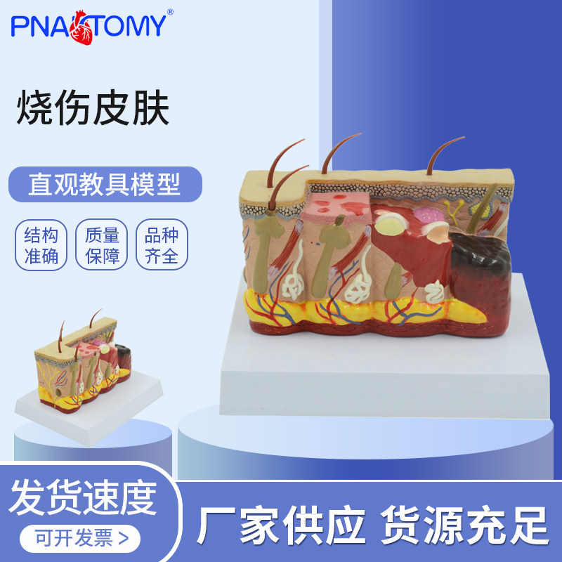 烧伤皮肤模型红斑水疱焦痂表皮破损创伤医学教学烧伤科诊疗培训演