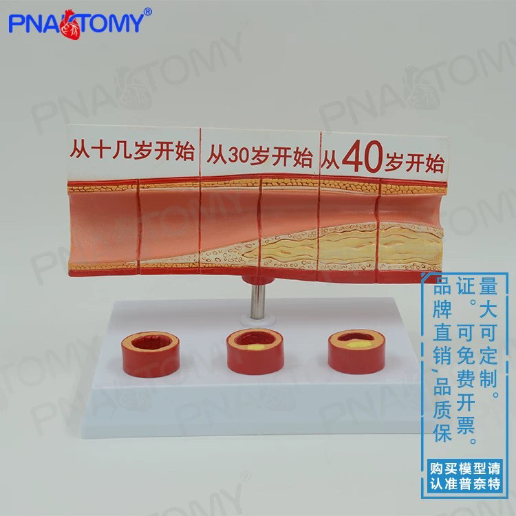 人体动脉血管堵塞模型心脑血管血栓/硬化模型 教学心脑血管科