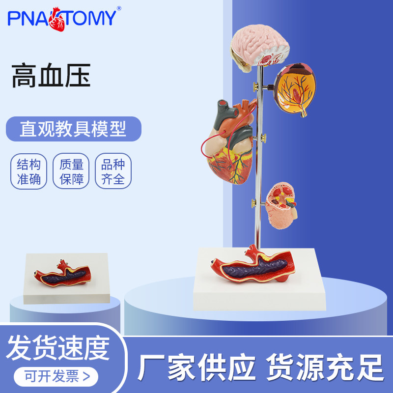 高血压病理演示模型动脉粥样硬化心脑血管损伤血压变化动临床医学