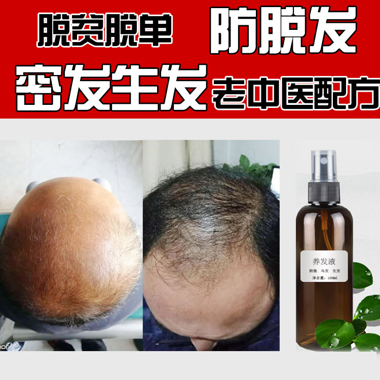 Hair fast growth liquid non-old ginger king herbal ancient formula raw hairpin to increase hair density and prevent hair loss and send the medicine device