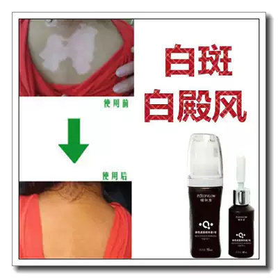 Children's masking Pen Waterproof and long-lasting white palace style external medicine to promote melanin growth liquid white spot net White Buster crazy Buster