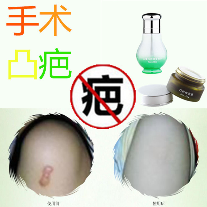 Remove hyperplasia to repair softening freeze pimples and scar cut scar cut scar scar scar scar scar scar scar scar scar scar scar scar scar scar scar scar scar scar scar scar scar scar scar scar scar scar scar scar scar scar scar scar scar scar scar scar scar scar scar scar scar scar scar scar scar scar scar scar scar scar scar scar