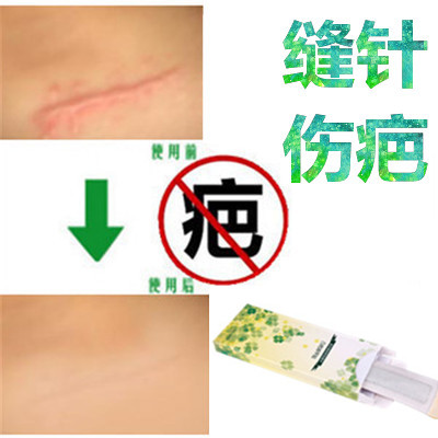 Removal of the post-operative scar Inspiritus Inspirant Frost Damage Repair The Proliferative Convex Scarlet With Smoke Scar Pigment Medicine