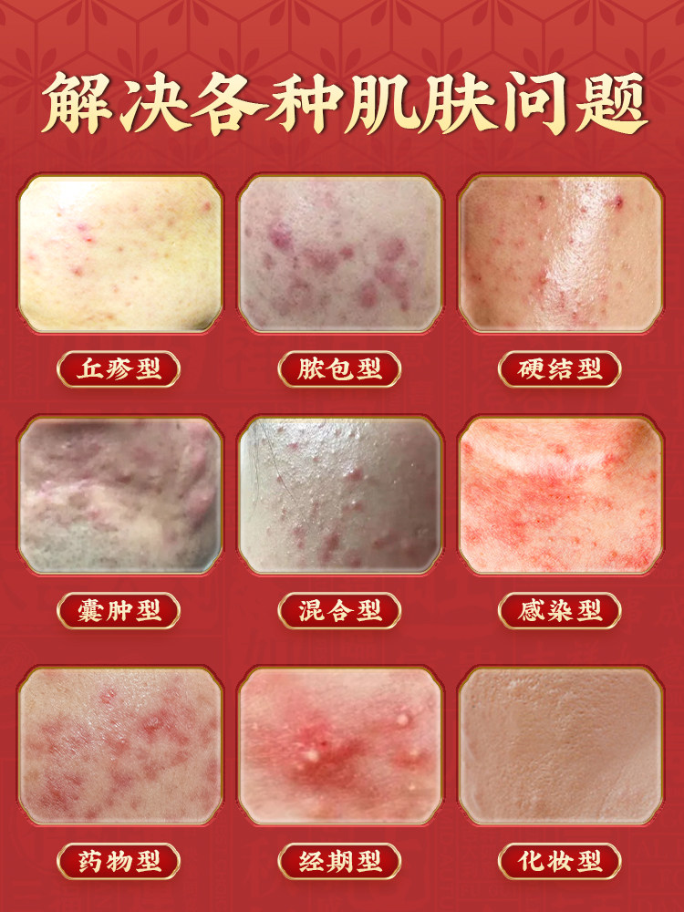 Acne-Removing Internal Tablets to Regulate Female Endocrine Disorders, Tea for Chin Acne, Men's Non-Detoxifying Beauty and Regulation