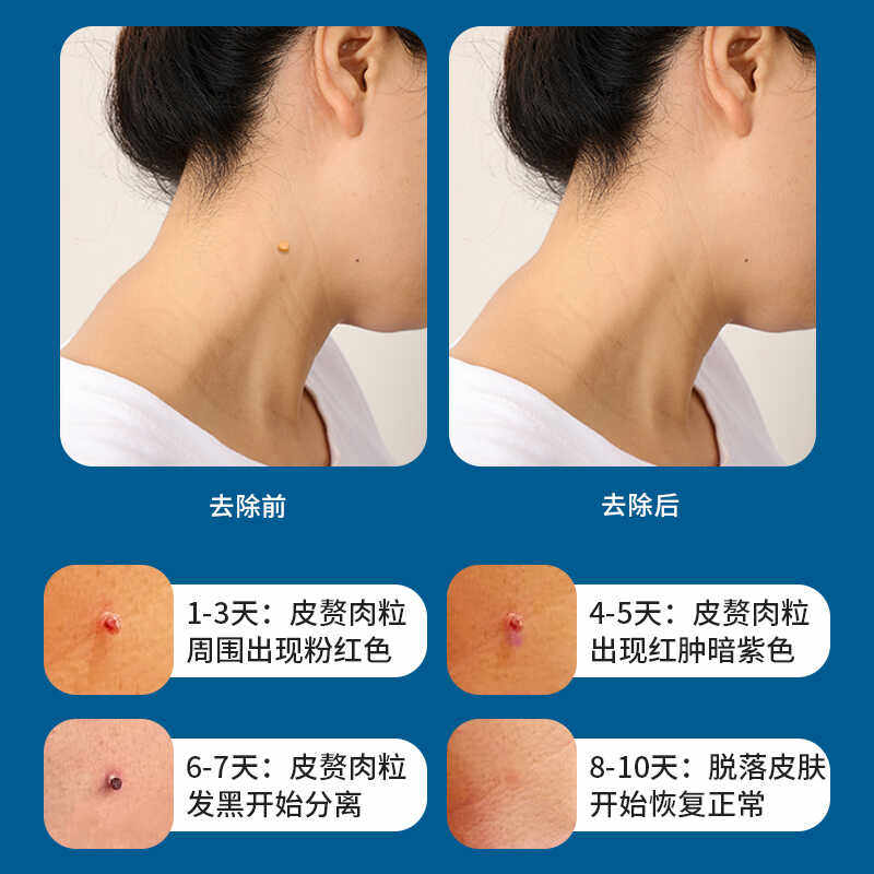 祛肉赘丝疣痦子神器，2-9毫米全搞定？深度测评与使用心得-其它工具-淘宝好物网