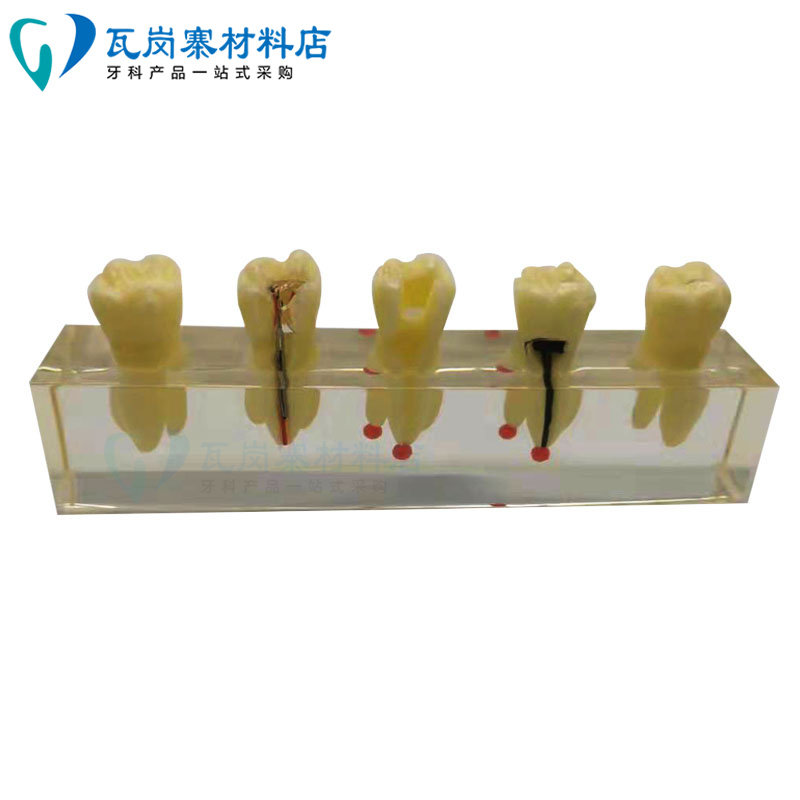 牙科口腔材料 4012 分解模型 牙齿龋坏发展 口腔医患沟通练习包邮