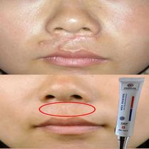 (Quick scar removal) Surgical scar hyperplasia repair burns dilution of bumps caesarean section melanin acne marks acne pits