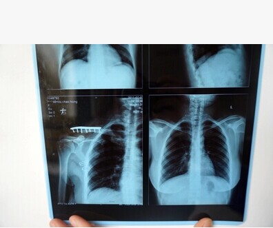 A4 -- Medical blue inkjet laser can be negative CR DR negatives CT negatives X-ray PET waterproof blue sheet