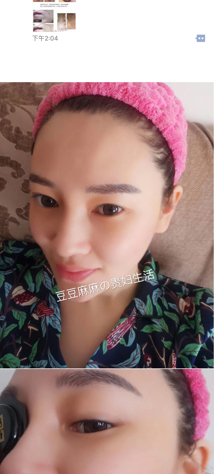 SF thứ hai tóc 1 thử Nhật Bản làm đẹp bằng dao siêu âm mặt nạ Nâng cơ để cải thiện khuôn mặt luật pháp shou mặt mặt nạ vitamin e