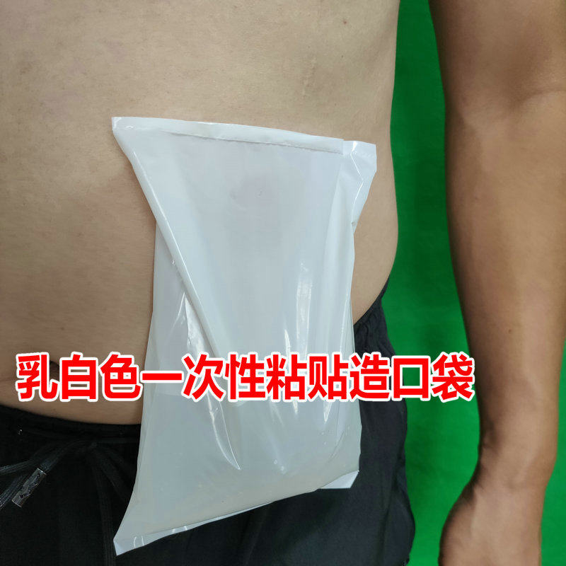 一件式造口袋腰部造瘘口直肠改道大便粪包乳白色粘贴式人造肛门袋
