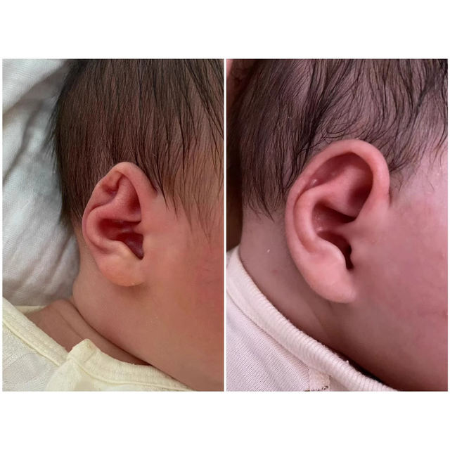 Ear corrector baby silicone newborn baby auricle ear support lop ear ear clip correction shaping artifact