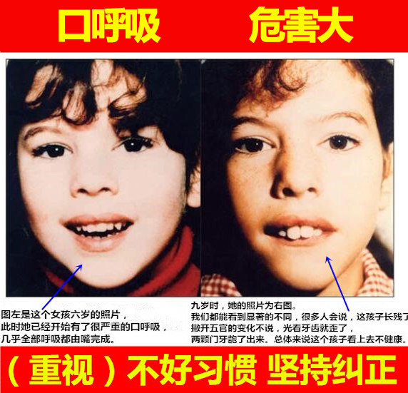 Oral breathing correction patch, anti-snoring artifact, anti-snoring device for children and adults, anti-opening mouth sealing, shut-mouth sleeping lip patch