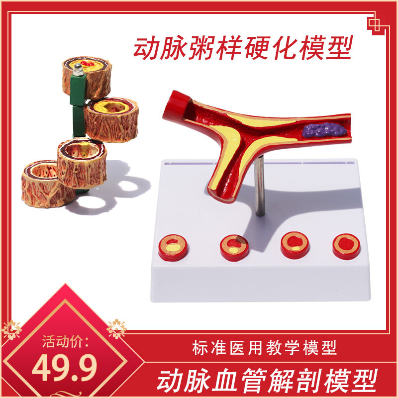 动脉粥样模型心血管动脉1硬化模型血管粥样/血管堵塞病理解剖模型