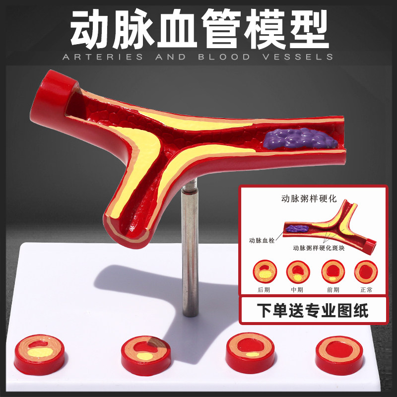 血管堵塞动支脉粥样硬化心血管模型病理动态血管血栓流动对比模型