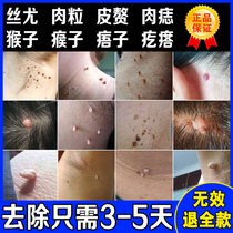 Skin wart sarcoma removal cream removes small fleshy pimples on the neck of monkeys