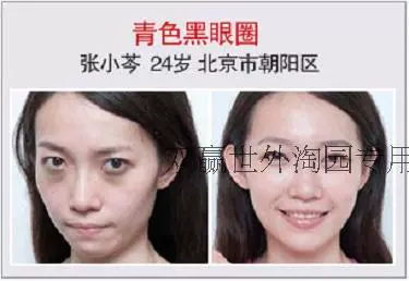 Zhuangdi Serum Mắt để Khử Mùi Tối Vòng Tròn Túi Mắt Dòng Fine Làm Săn Chắc Nhẹ Nhàng Thảo Dược Giải Pháp Chăm Sóc Mắt lăn mắt