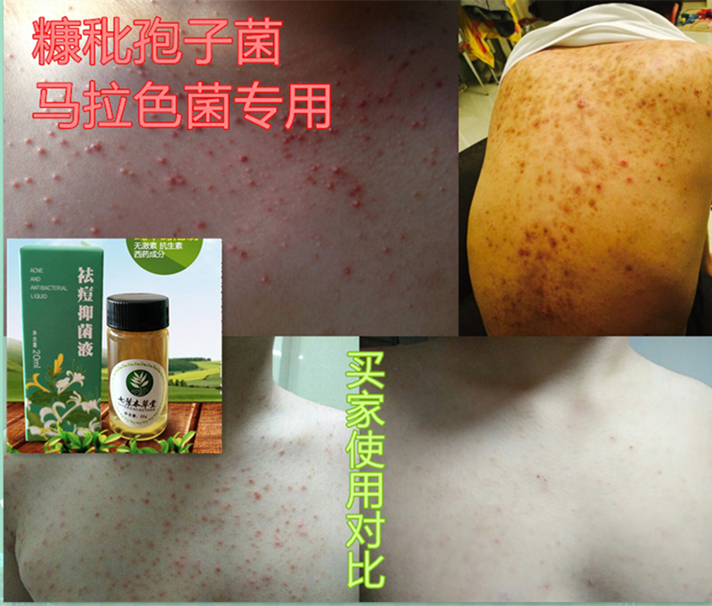 Antibacterial Liquid for Treating Acne in Hair Follicles Caused by *Bacillus Subtilis* and *Malassezia*, Specifically for Red Spots on the Chest, Back, and Face