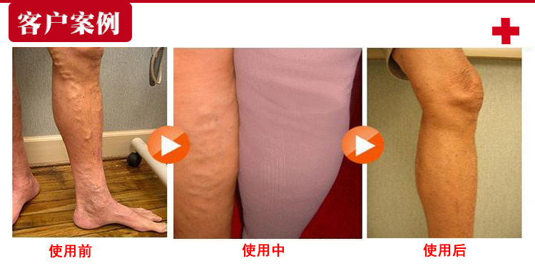 Chaussettes - collants manchon médical de veau - Ref 753919 Image 28