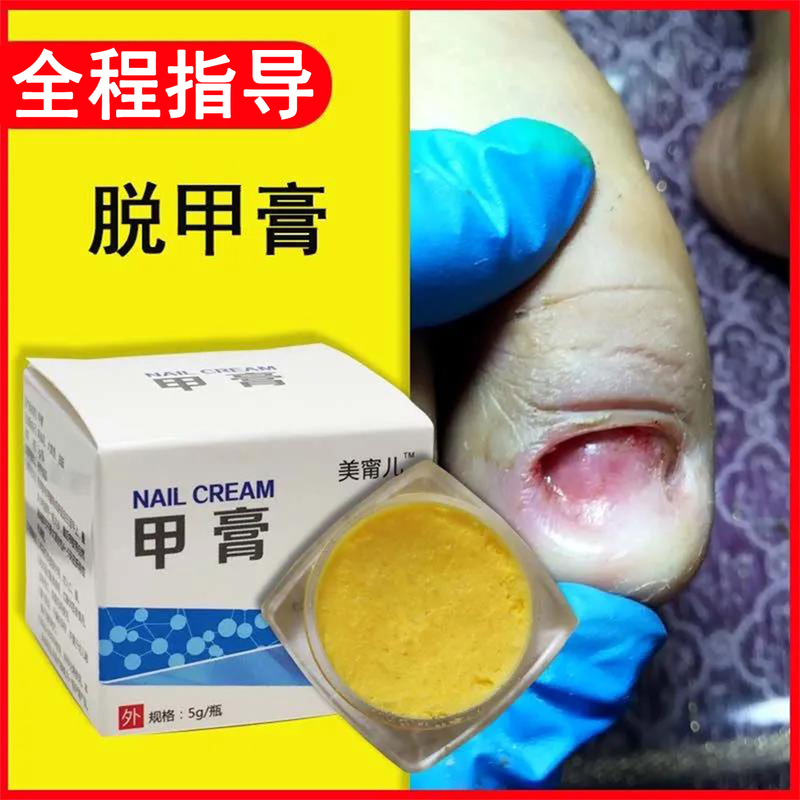 Special Nail Removal Cream, Soft Nail Cream, Quick Nail Removal, Painless Removal of Discoloration, Thickening, and Antibacterial Special Effect Cream