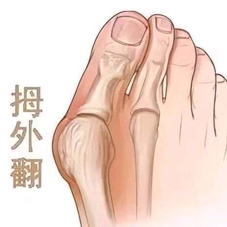 拇外翻矫正杨教练