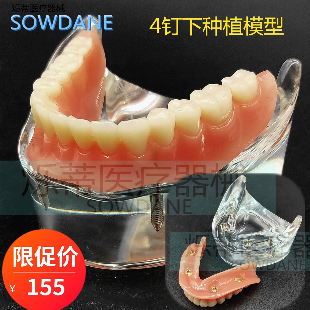 Dental Teaching Planting Model 4 Nails Mandibular Doctor-patient Communication Transparent Model Dental Mold Simulation