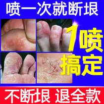 Treat the foot and stop itching to remove the pitchy foot girl with the root special effect Hong Kong foot special minced toe slit