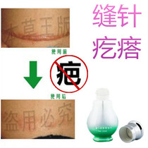 After removing the stitches repair fluid for surgical bumps and falls remove cesarean section bumps knife scars smoke scars cream