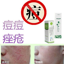 Wine thorn cream removes acne marks on the back removes acne marks on the back removes acne marks on the chest and removes acne marks on the chest.